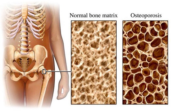 Osteoporoz