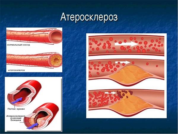 Атеросклероз в сосудах