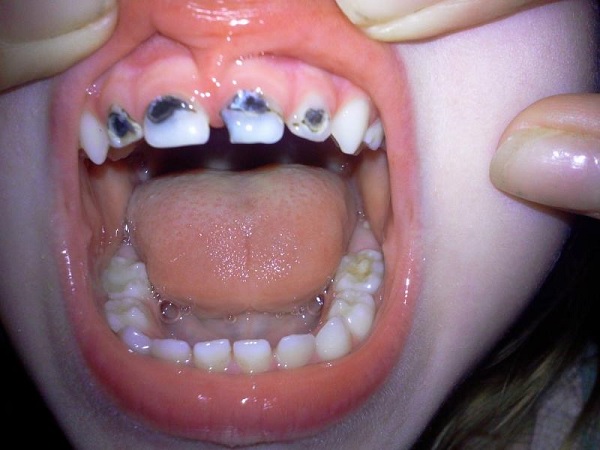 Кариес передних зубов