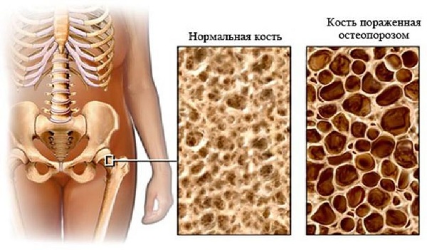Признаки остеопороза