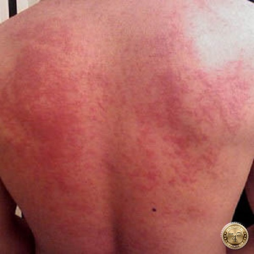 аллергия на спине