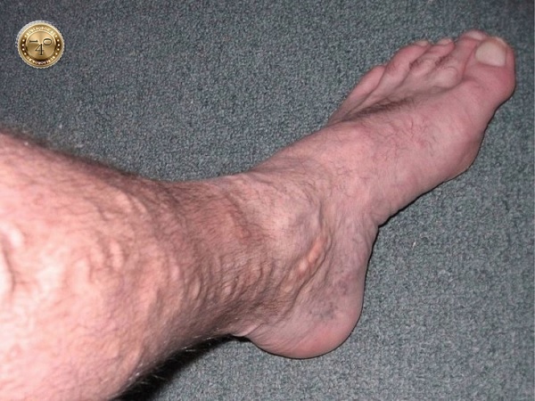 варикоз ног