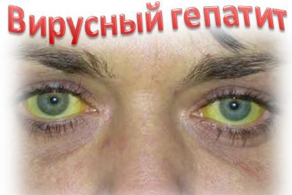 Глаза при вирусном гепатите