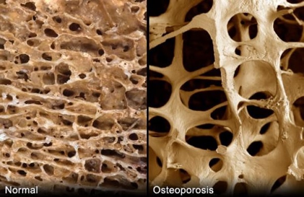 Osteoporisis