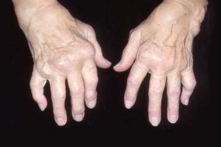руки больного остеоартритом