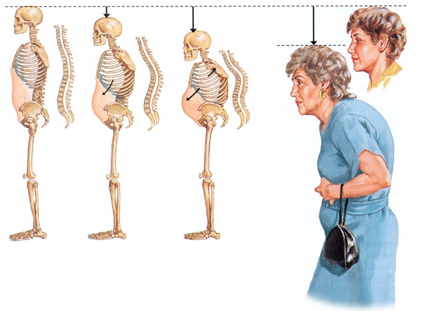 Последствия остеопороза у женщин