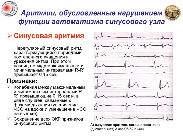аритмия сердца