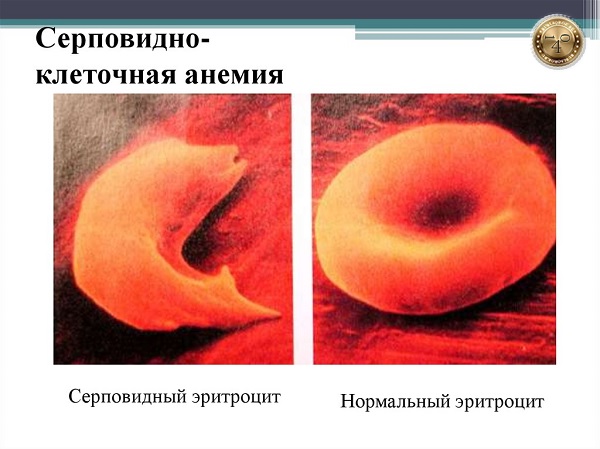 серповидно-клеточная анемия